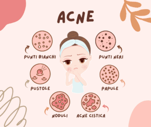 ayurveda acne | Ayueway