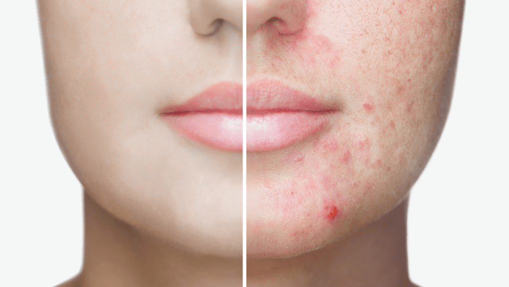 ayurveda acne | Ayurway